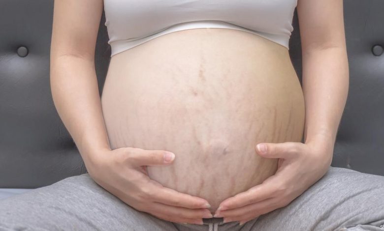 علاج تشققات البطن بعد الولادة